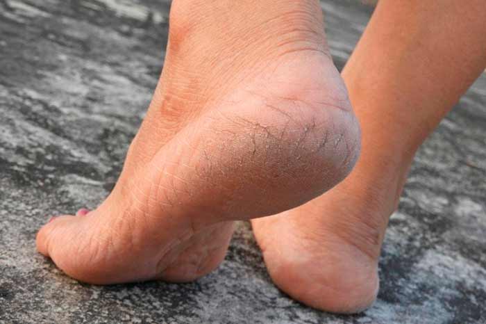 Потрескавшейся кожа на пятках: несколько домашних средств не потребующих серьезных расходов